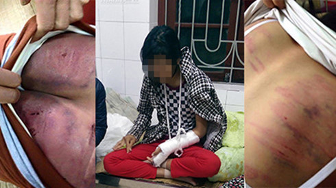 Thái Nguyên: Bố đánh con trai 13 tuổi bầm mông, rướm máu phải nhập viện - Ảnh 1.