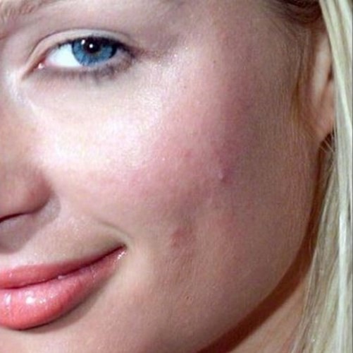 Khi loạt sao Hollywood đau đầu, &ldquo;khổ sở&rdquo; v&igrave; mụn trứng c&aacute; - Ảnh 14.