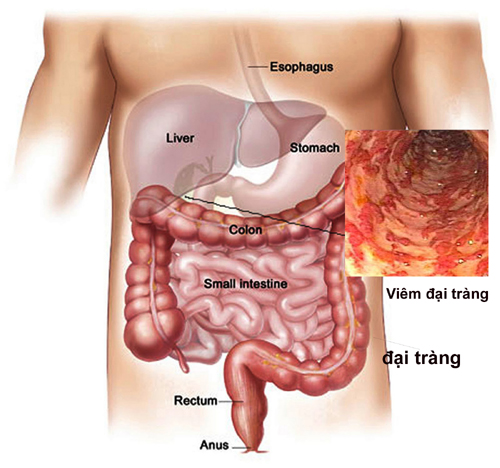 Những món ăn đưa con người tới gần hơn với ung thư đại trực tràng - Ảnh 1.