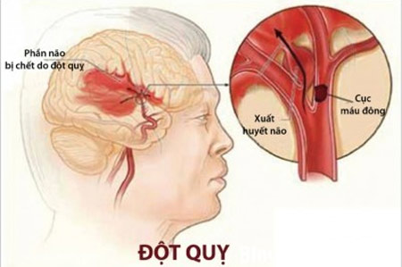 6 người thì có 1 người tiềm ẩn nguy cơ bị đột quỵ: Bạn tránh tử vong cách nào? - Ảnh 1.