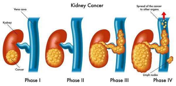 Các giai đoạn ung thư thận - Ảnh 1.