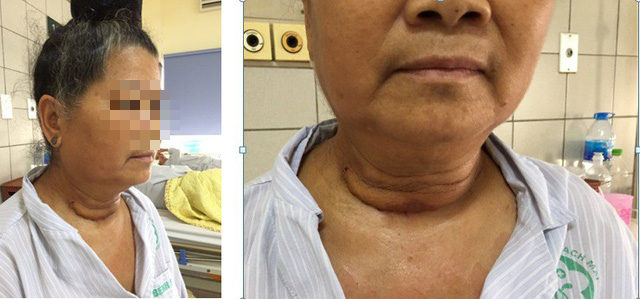 Cắt khối u trung thất khổng lồ nằm im 10 năm trong lồng ngực người phụ nữ - Ảnh 1.