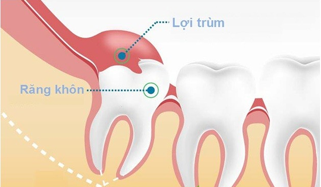 Răng khôn: Nỗi ám ảnh không của riêng ai - Ảnh 2.