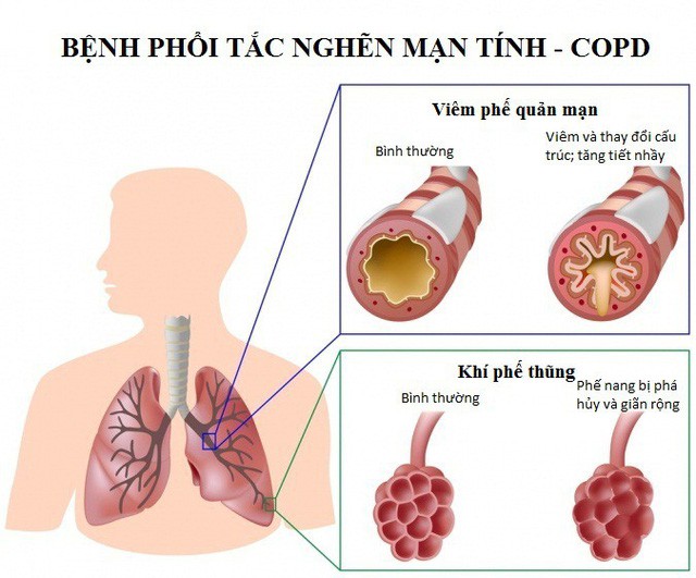 Bệnh phổi tắc nghẽn mạn tính, hen phế quản - gánh nặng của mỗi gia đình và cả cộng đồng - Ảnh 1.