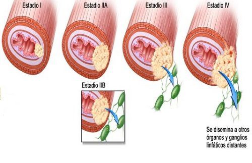 Cần làm gì khi mắc ung thư thực quản giai đoạn cuối? - Ảnh 1.