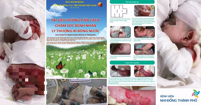 Gian nan hành trình chăm sóc trẻ bị ly thượng bì bóng nước - Ảnh 2.