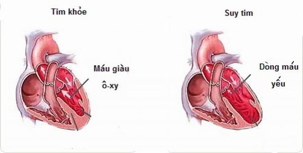 Ai dễ bị suy tim? - Ảnh 2.