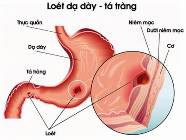 Biến chứng nguy hiểm từ loét dạ dày tá tràng - Ảnh 1.