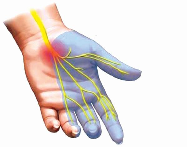 Hội chứng ống cổ tay: Bệnh không nên chủ quan - Ảnh 1.