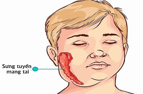 Nhận biết sớm bệnh quai bị ở trẻ em để ngăn ngừa biến chứng - Ảnh 1.