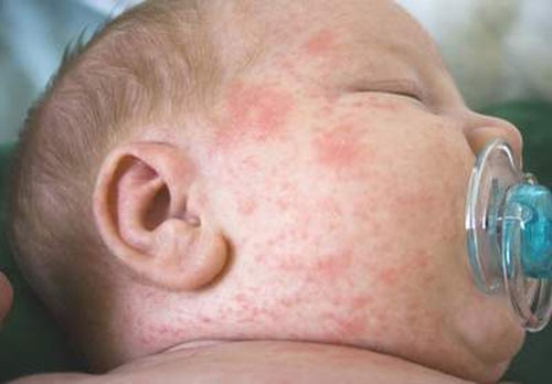 Sốt xuất huyết Dengue - Những kiến thức không thể bỏ qua - Ảnh 2. Sốt xuất huyết Dengue - Những kiến thức không thể bỏ qua - Ảnh 2.