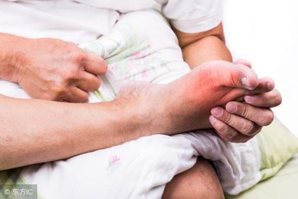 Triệu chứng nào cảnh báo bệnh Gout? - Ảnh 1.