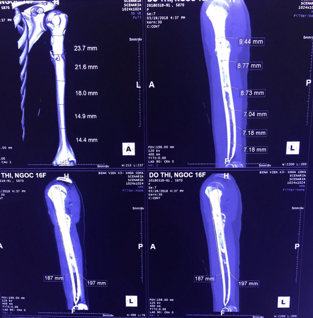 Phẫu thuật bảo tồn cánh tay cho nữ bệnh nhân ung thư xương - Ảnh 1.