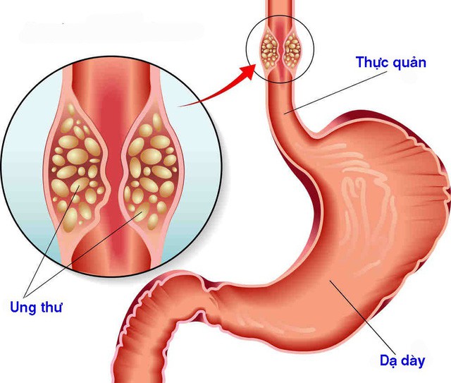 Nuốt nghẹn - dấu hiệu cảnh báo ung thư thực quản - Ảnh 2.