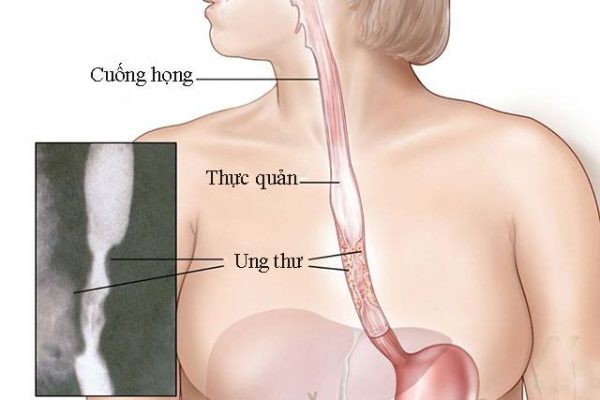 Tỷ lệ chữa khỏi bệnh của ung thư thực quản - Ảnh 1.