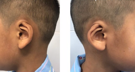 Trẻ sinh ra có vành tai bị vùi lấp được phẫu thuật tạo hình thành công - Ảnh 1. Trẻ sinh ra có vành tai bị vùi lấp được phẫu thuật tạo hình thành công - Ảnh 1.