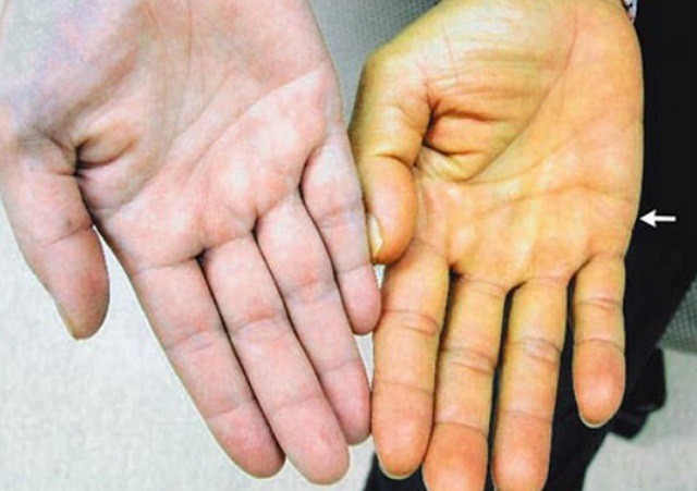 6 triệu chứng ung thư gan ai cũng cần phải biết - Ảnh 3. 6 triệu chứng ung thư gan ai cũng cần phải biết - Ảnh 3.