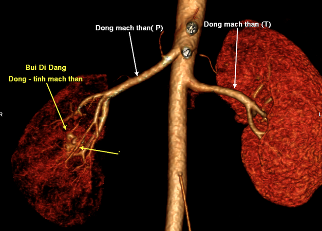Can thiệp nội mạch thành công di động tĩnh mạch hiếm gặp ở thận  - Ảnh 1.