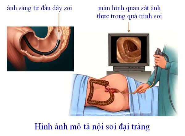 Cách phát hiện sớm ung thư đại tràng - Ảnh 3.