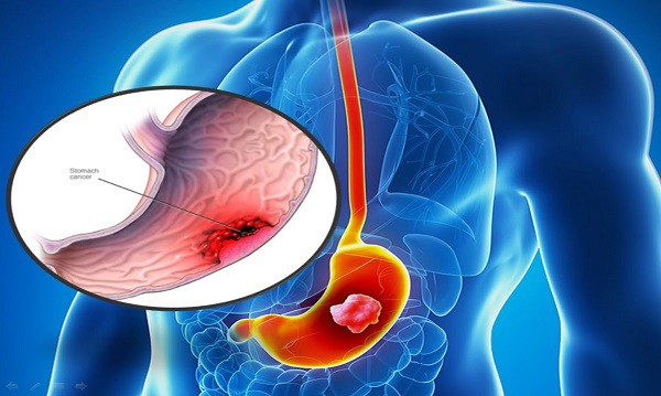 Vi khuẩn HP làm tăng nguy cơ mắc ung thư dạ dày - Ảnh 3.