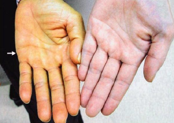 Những triệu chứng cảnh b&aacute;o vi&ecirc;m gan B - Ảnh 2.