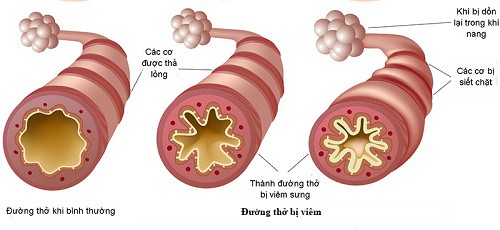 Điều trị viêm phế quản mạn bằng Đông y - Ảnh 1.