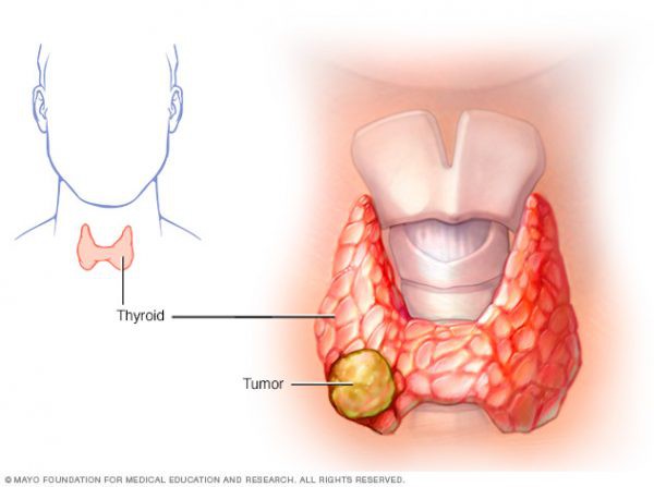 Các dạng ung thư tuyến giáp và phương pháp điều trị - Ảnh 1.