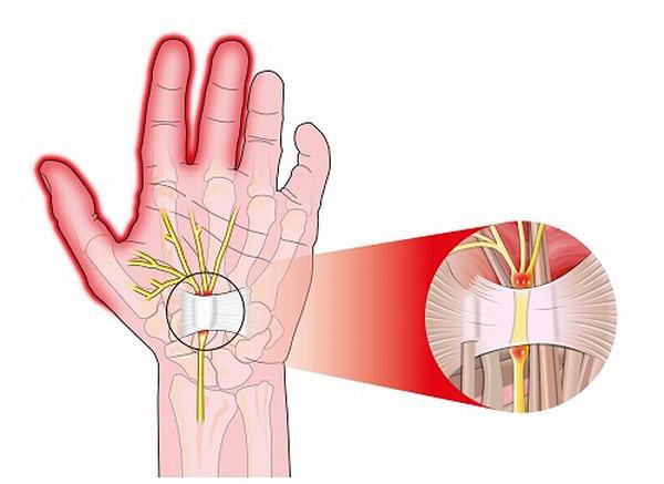 Cách làm giảm đau đầu ngón tay hiệu quả và dễ thực hiện tại nhà