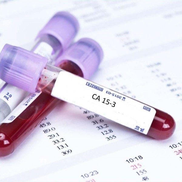 Chỉ số CA 15-3 cao có phải bị ung thư vú không? - Ảnh 1. Chỉ số CA 15-3 cao có phải bị ung thư vú không? - Ảnh 1.