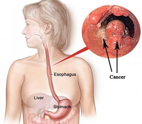 Dấu hiệu cảnh giác với ung thư thực quản - Ảnh 1. Dấu hiệu cảnh giác với ung thư thực quản - Ảnh 1.