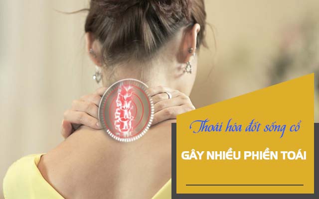 Nguy cơ bại liệt từ bệnh lý thoái hóa đốt sống cổ - Ảnh 3.