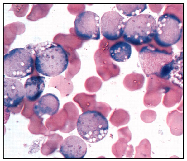 Bệnh ung thư m&aacute;u ở trẻ em - Ảnh 1.