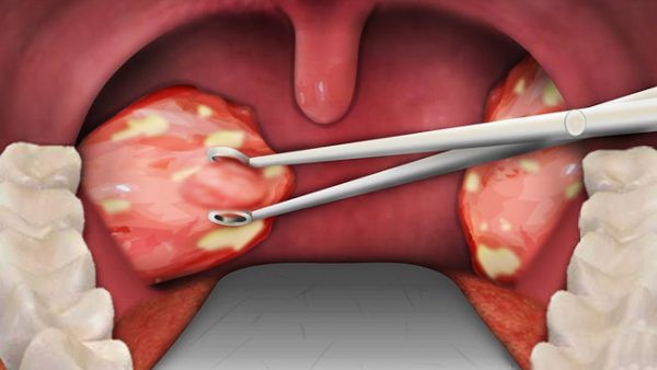 Nổi hạch ở cổ có nguy hiểm không? - Ảnh 1.