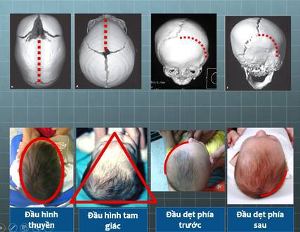 Phẫu thuật thành công các trường hợp biến dạng hộp sọ kèm não úng thủy - Ảnh 1.