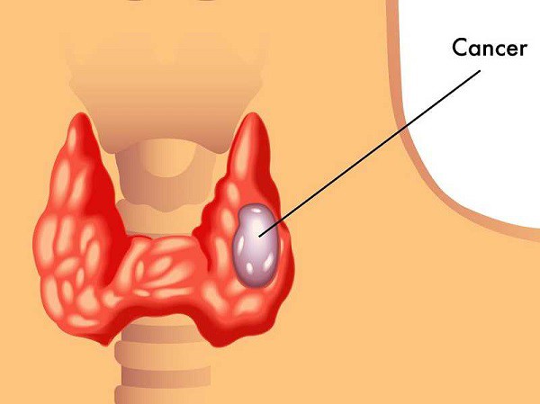 Làm sao để biết mắc ung thư tuyến giáp hay không? - Ảnh 1.