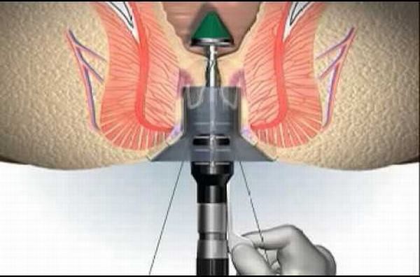Triệu chứng bệnh trĩ thường gặp - Ảnh 1. Triệu chứng bệnh trĩ thường gặp - Ảnh 1.