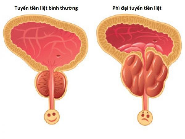 Phì đại tuyến tiền liệt và ung thư tuyến tiền liệt - Ảnh 1. Phì đại tuyến tiền liệt và ung thư tuyến tiền liệt - Ảnh 1.