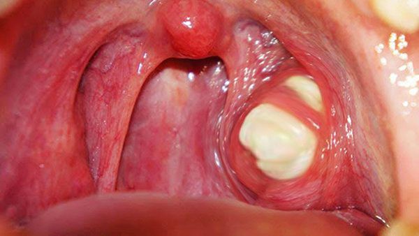 Phân biệt viêm amidan có mủ và ung thư vòm họng - Ảnh 1. Phân biệt viêm amidan có mủ và ung thư vòm họng - Ảnh 1.
