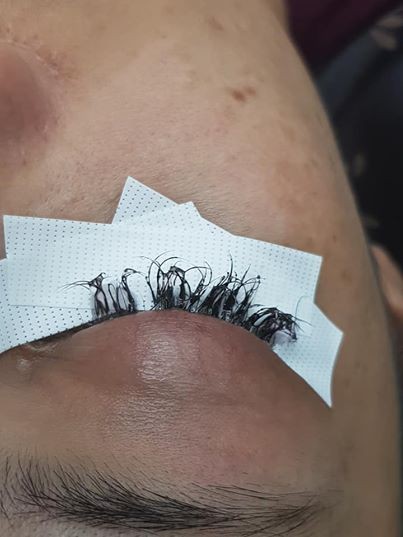 Rụng toàn bộ lông mi vì nối mi ở tiệm - Ảnh 1.