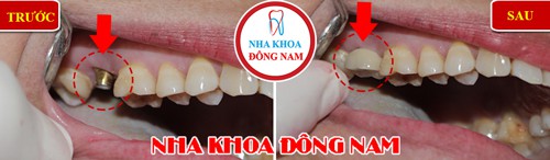 Bạn hiểu cấy ghép răng Implant là như thế nào không? - Ảnh 1. Bạn hiểu cấy ghép răng Implant là như thế nào không? - Ảnh 1.