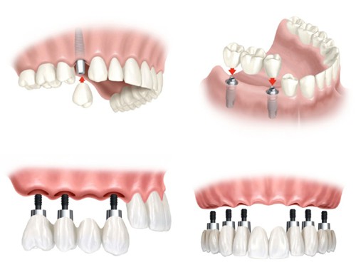 Bạn hiểu cấy ghép răng Implant là như thế nào không? - Ảnh 2. Bạn hiểu cấy ghép răng Implant là như thế nào không? - Ảnh 2.