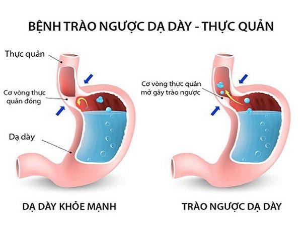 Nguyên tắc ăn uống cho người trào ngược axit dạ dày thực quản - Ảnh 1.