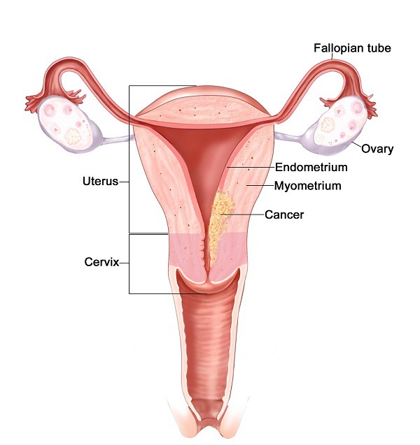 Độ tuổi nào dễ mắc ung thư tử cung? - Ảnh 1.