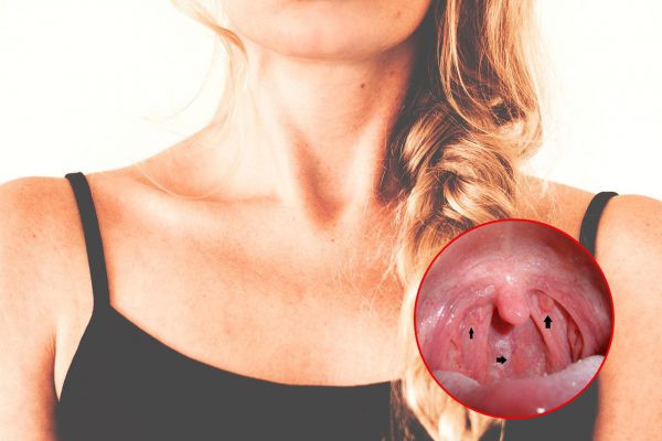 Khi nào nên khám ung thư vòm họng? - Ảnh 1. Khi nào nên khám ung thư vòm họng? - Ảnh 1.