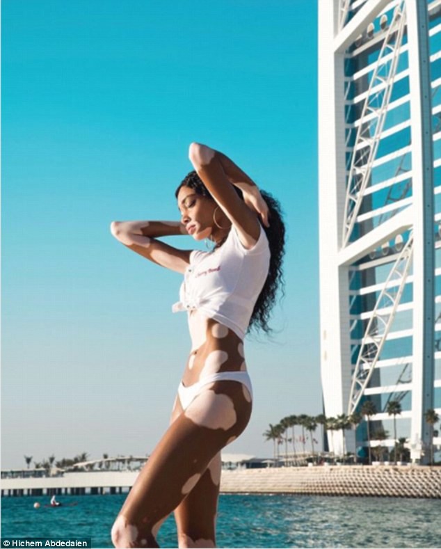 Winnie Harlow khoe dáng thon gọn - Ảnh 10. Winnie Harlow khoe dáng thon gọn - Ảnh 10.