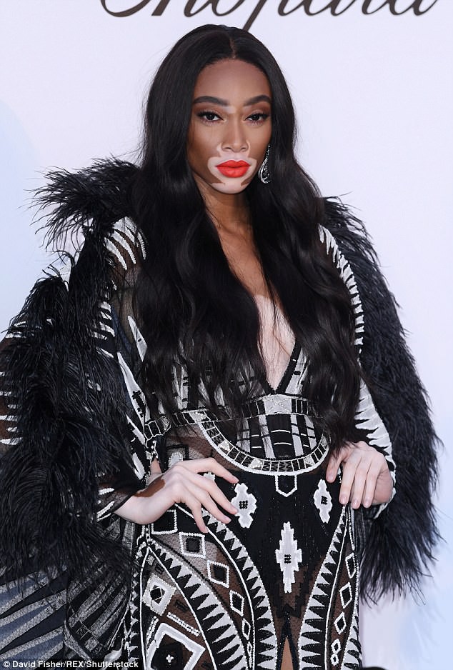 Si&ecirc;u mẫu bị bạch biến khoe d&aacute;ng gợi cảm - Ảnh 6.