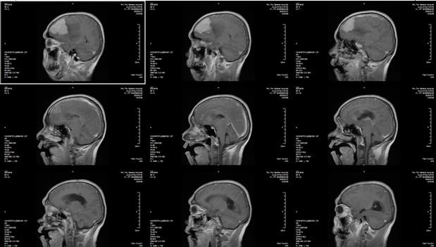 Đau đầu, đến bệnh viện phát hiện u màng não khổng lồ  - Ảnh 1.