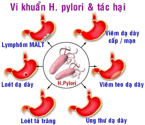 Vi khuẩn HP: Mối lo nguy hiểm cho dạ dày - Ảnh 1.