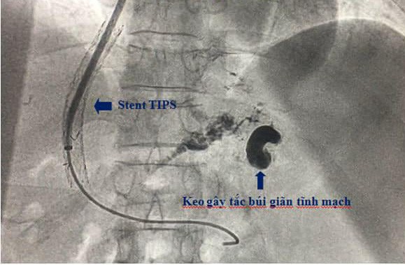 Cấp cứu người đàn ông máu chảy xối xả do xơ gan - Ảnh 1.