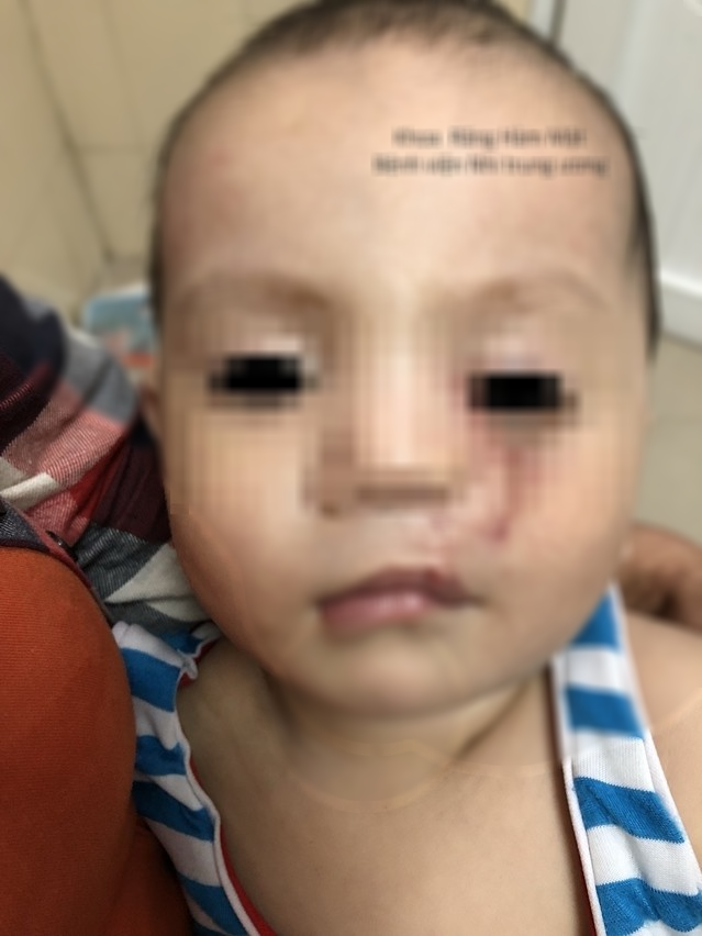Phẫu thuật th&agrave;nh c&ocirc;ng cho b&eacute; trai c&oacute; khe hở ch&eacute;o mặt hiếm gặp - Ảnh 1.